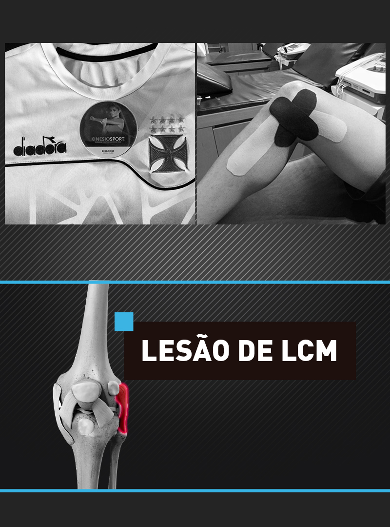 Lesão do ligamento colateral medial